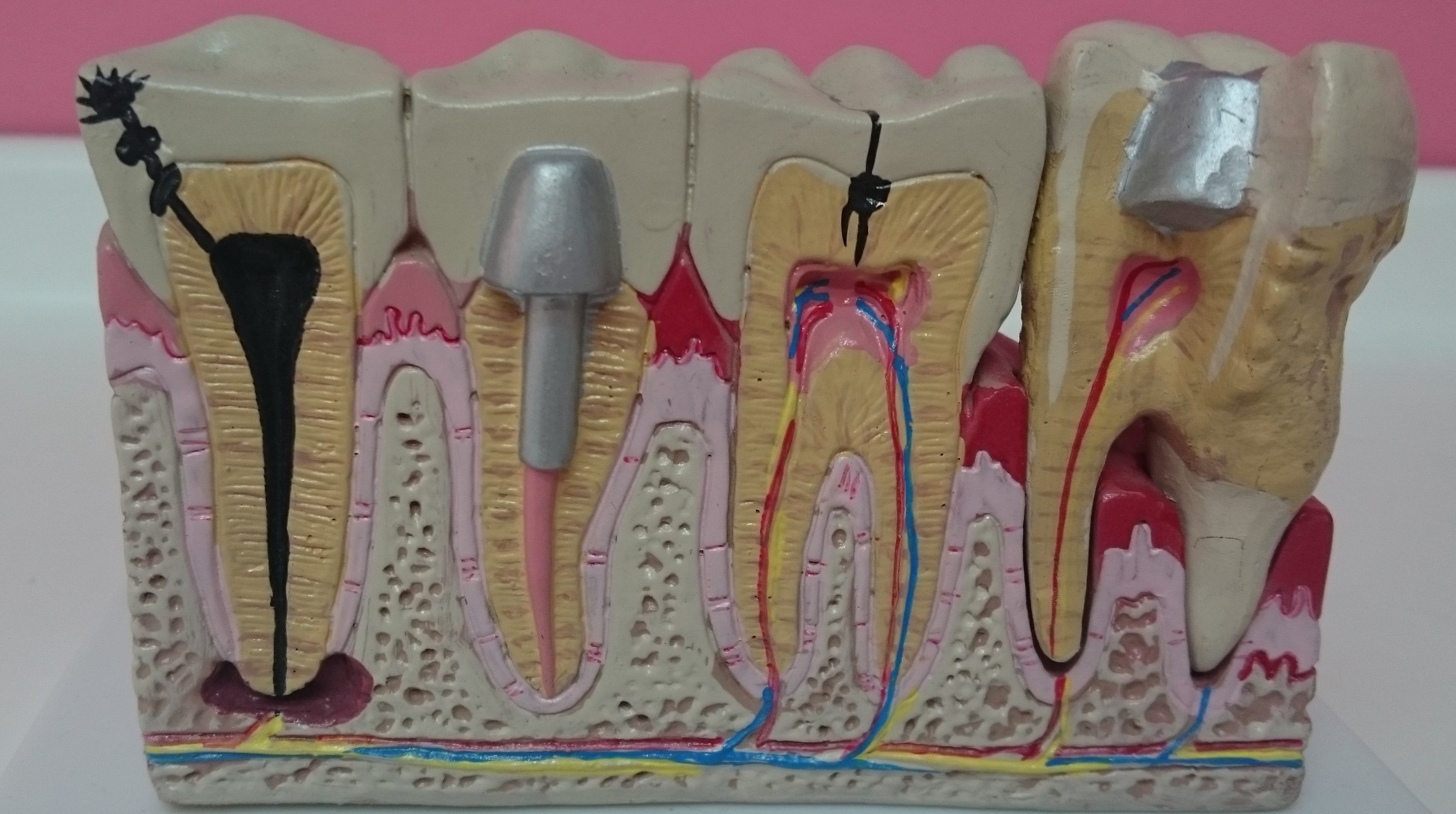qué la endodoncia o desvitalización de un diente? | Presencia